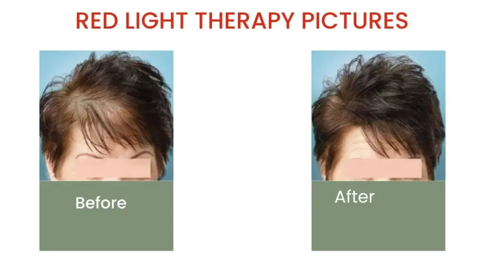 Red Light Therapy Before and After Pictures