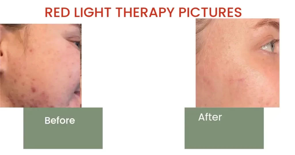 Red Light Therapy Pictures