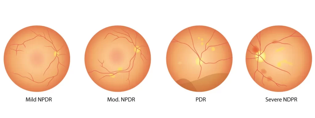 4-stages-diabetic-retinopathy