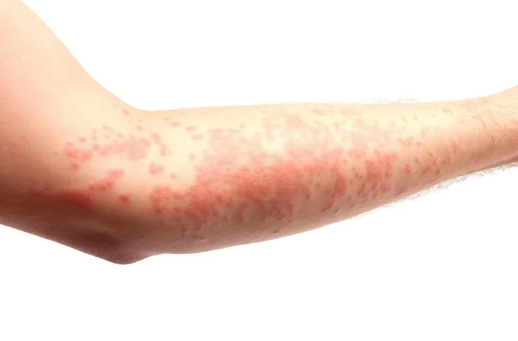 Eczema Skin Problems