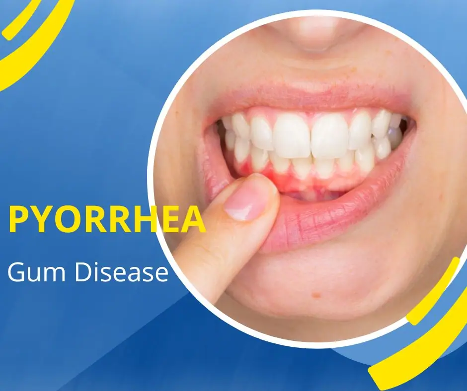 Pyorrhea Gum Disease